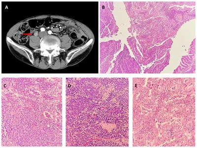 Ureter mixed neuroendocrine-non-neuroendocrine neoplasm: a case report and literature review